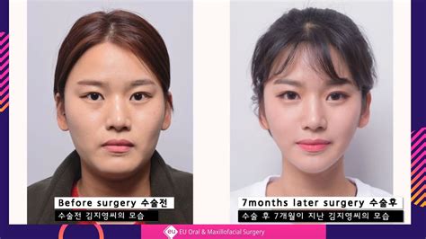 Facial Contouring V Line Surgery And Cheekbone Reduction Surgery Review