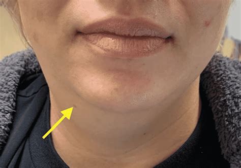 Cureus Acute Submandibular Sialadenitis