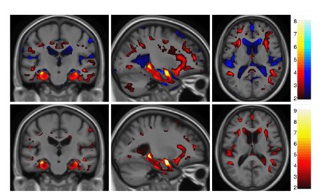 Statistical Maps Of Brain Atrophy In The Selected Population N120