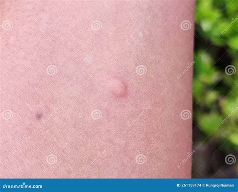 A Mosquito Bites A Blister On The Arm Stock Photo Image Of Mosquito