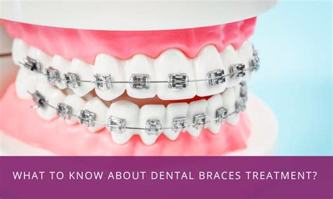 All You Must Know About Dental Braces Treatment