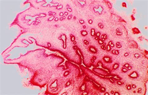 Tumor Exophytic Papillary Lesion With Arborizing Fibrovascular Core