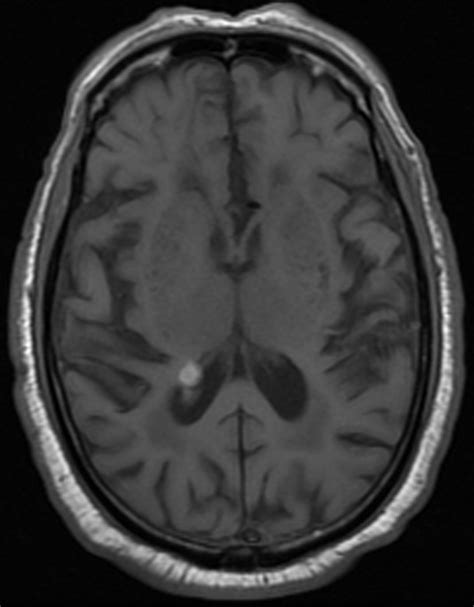 Noncontrast T1 Weighted Brain Mri Image Demonstrates Hemorrhage