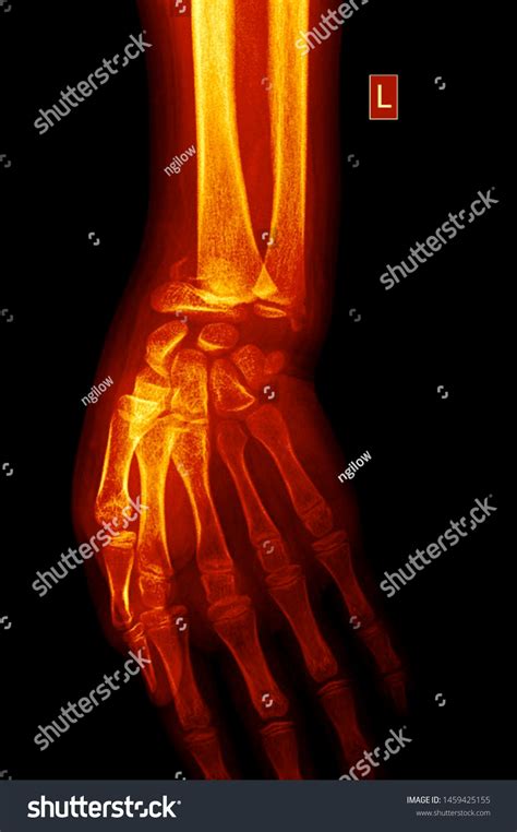 Wrist X Ray Anatomy Radiology Radiographic Stock Photo 1459425155