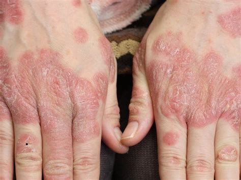 手湿疹の原因はストレス？ぶつぶつや痛みの原因と対処法4選【画像付】