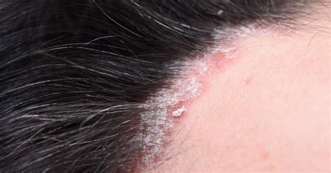 Apratim goel has shared about these two scalp conditions. Psoriasis or Dandruff. Symptoms, Differences, Care ...