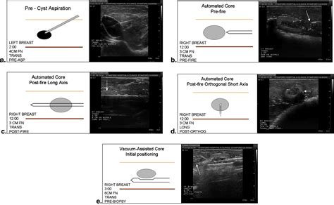 Utilizing A Pacs Integrated Ultrasound Guided Breast Biopsy Simulation