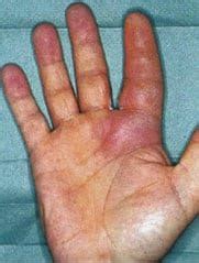 Flexor Tenosynovitis Hand