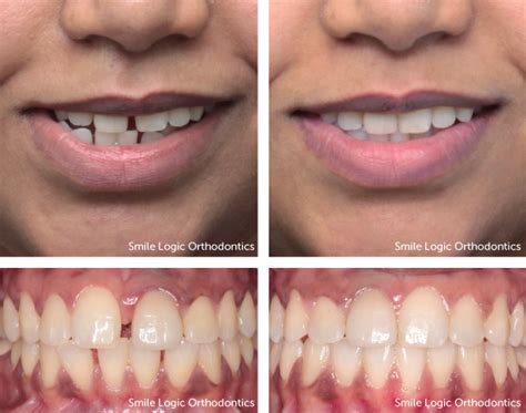Invisalign Before And After Spacing