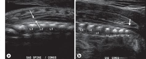Spina Bifida Ultrasound