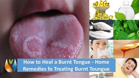How To Heal A Burnt Tongue Home Remedies Fo Treating Burnt Toungue