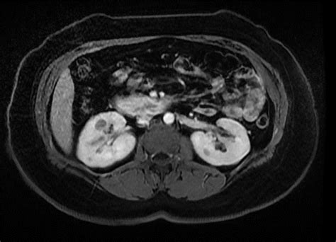 Mr Abdomen With And Without Contrast Greater Waterbury Imaging Center