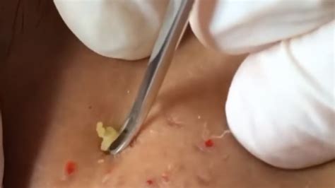 How To Satisfying Blackhead Removal From Face Youtube