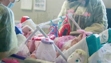 texas conjoined twins successfully separated after 15 hour surgery