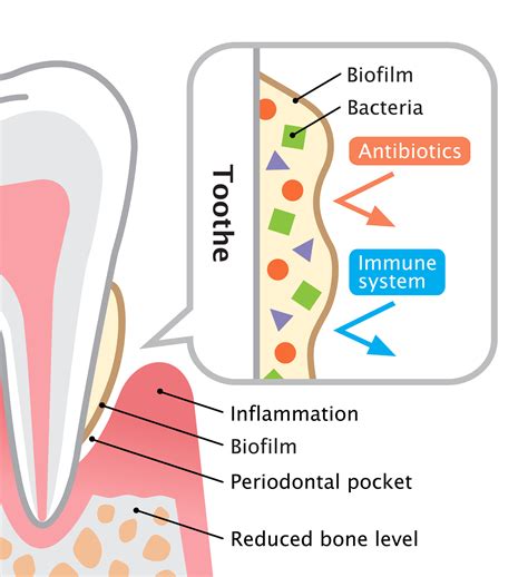 Biofilm On Tooth Illustration Dental And Oral Care Concept Citrisafe