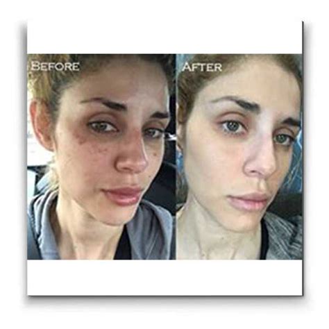 Lumecca Ipl Treatment La Beauty Skin Center