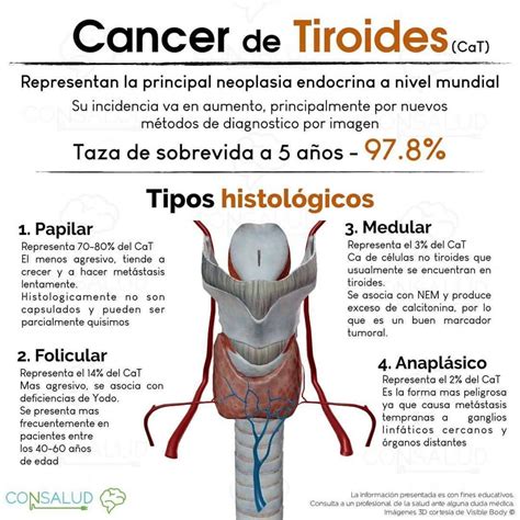 Etiologia De Lcancer Tipos De Cancer Tiroideo