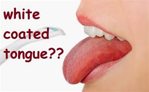 Home Remedies Home Remedies For White Coated Tongue