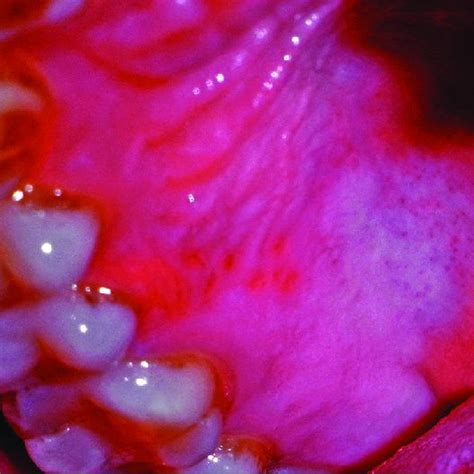Multiple Oral Ulcers On Gingiva And Palate As Seen In Primary Herpetic