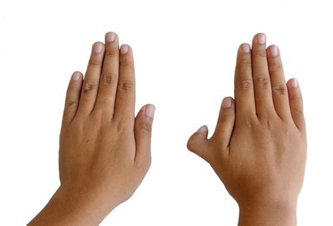 6 fingers polydactylism why are some people born with an extra digit fingers