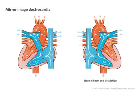 Cardiology Mirror Image Dextrocardia