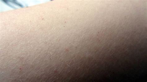 Rote Pünktchen auf dem Arm (Haut, Punkte)