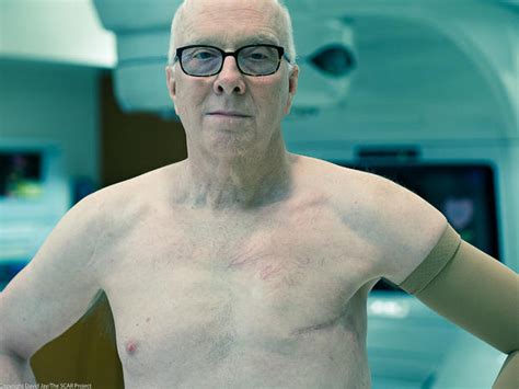 The Scar Project Picturing Male Breast Cancer Pictures Cbs News