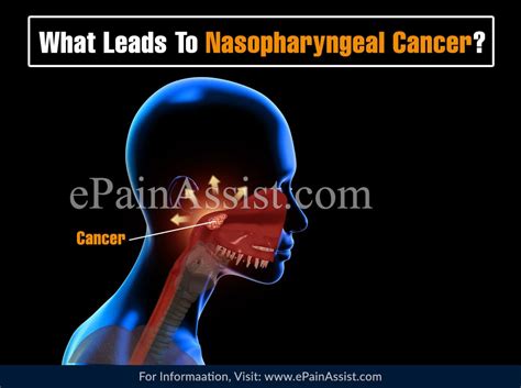 Nasopharynx Cancer Anatomy And Images