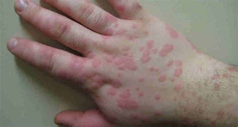 Hives Ayurvedic Treatment Home Remedies Causes And Symptoms