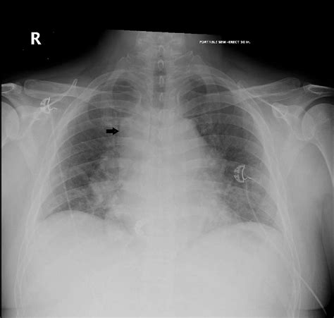 Cureus An Unusual Case Of Chronic Kidney Disease With Mediastinal