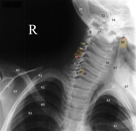 Radiographic Anatomy Of The Skeleton Cervical Spine Right Anterior