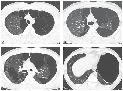 Emphysema And Chronic Obstructive Pulmonary Disease Thoracic Key