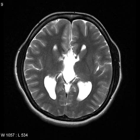 Corpus Callosum Dysgenesis Radiology Case Radiopaedia Org