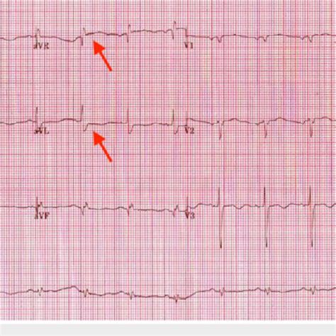 Electrocardiogram Revealed St Segment Elevation In Lead Avr And