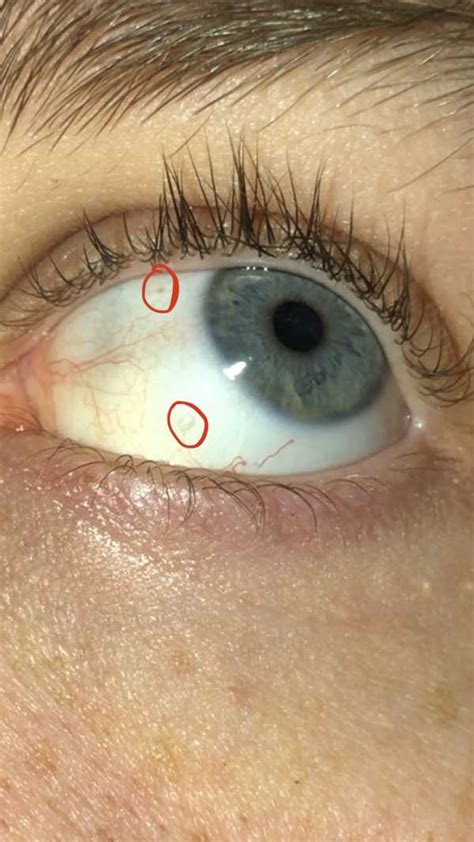 Grey Raised Dots On Eye Web Eye Clinic