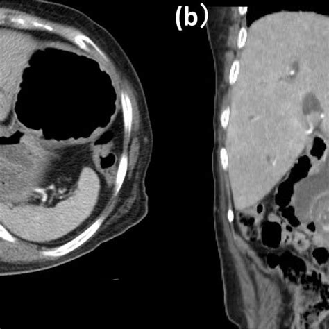 Ercp A Major Duodenal Papilla Could Not Be Visually Recognized