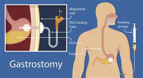 Perform Gastronomy Feeding Nurses Revision