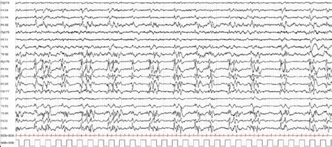 Periodic Lateralized Epileptiform Discharges Pleds Plus Pleds Plus