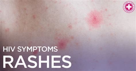 Maculopapular Rash Hiv Symptoms