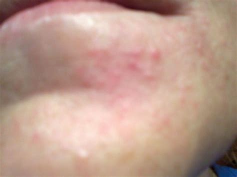 Rash On Face Small Blister Type Rash From Corners Of Mouth Down To