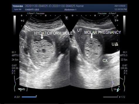 Ultrasound Video Showing Hydatidiform Mole Also Called Molar Pregnancy