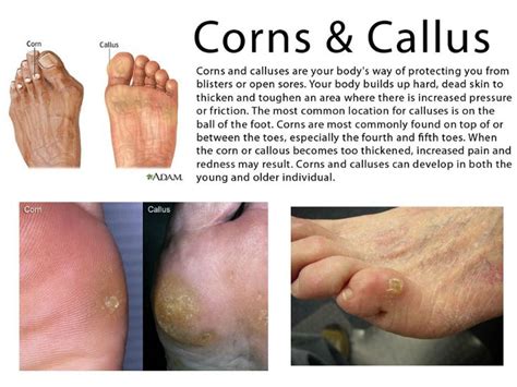How To Remove Corns And Calluses Naturally Corn Removal Toe Corn