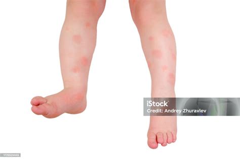 유아 아기 피부 관리 알레르기 및 피부염 흰색 배경에 격리 어린이 피부에 알레르기와 아토피 성 피부염의 붉은 반점 고립 된 흰색