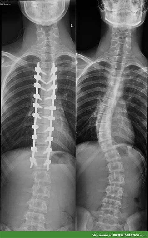 Scoliosis Surgery Before And After X Rays Funsubstance