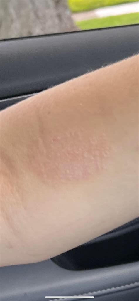 Skin Condition Mystery Ive Had A Circular Rash With Raised Bumps That