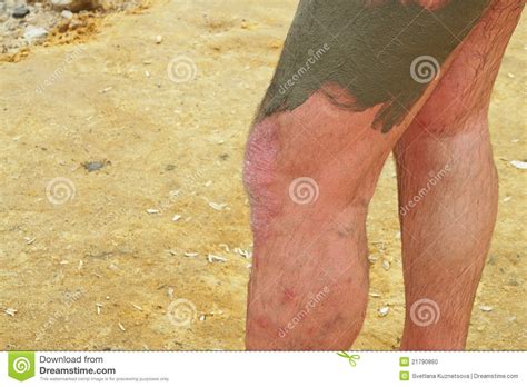 Psoriasis On The Men S Feet Treatment With Mud Stock Photo Image Of