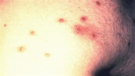 hiv rash what does it look like and how is it treated
