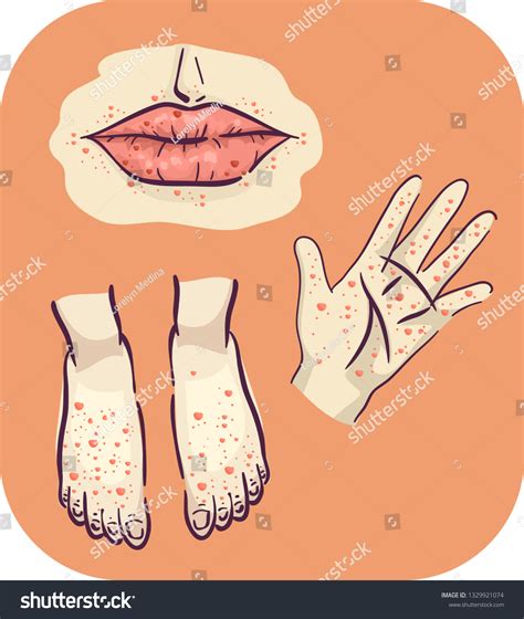 Illustration Rashes On Hand Feet Mouth Stock Vector Royalty Free 1329921074 Shutterstock