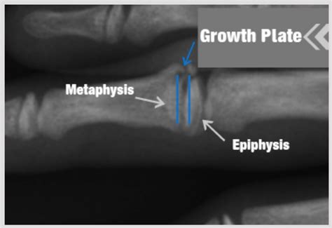 Growth Plate Fractures Part 1