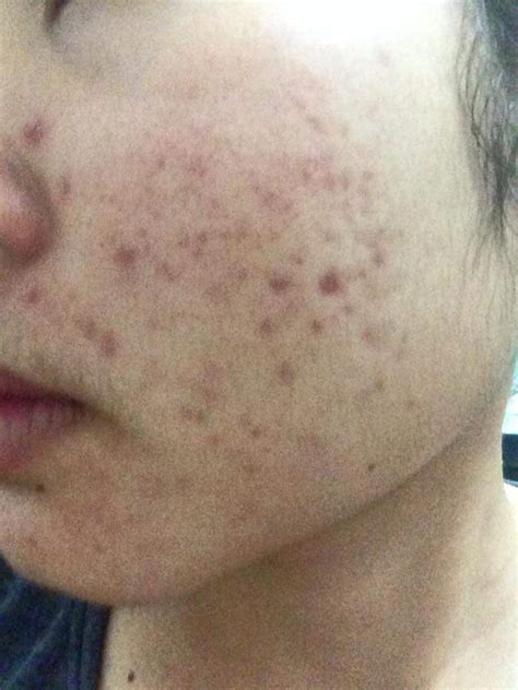 Please Could You Give Me An Advice On My Acne Scars